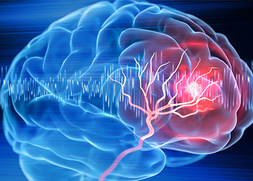 Recurrence of brain stroke